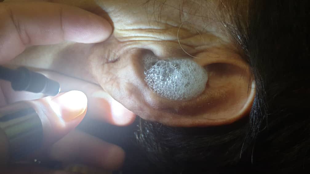 Angie Earspa ear bath foam treatment