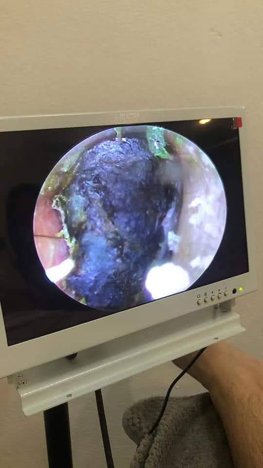 Angie Earspa ear stone and deep ear cleaning inspection